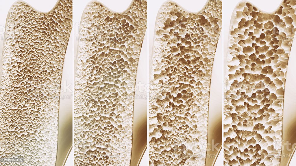 Vitamin D deficiency Symptoms and Diseases