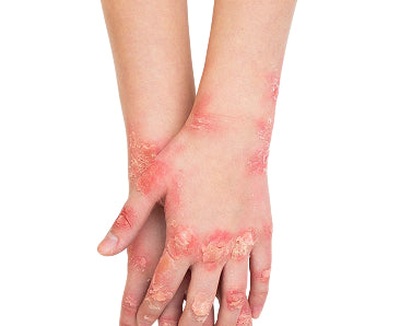 Psoriasis Diet Plan