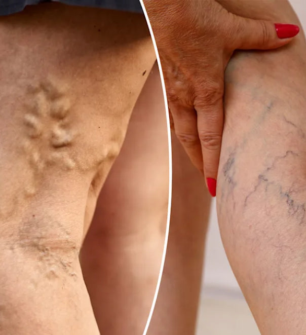 Varicose Veins / Spider Veins Diet Plan
