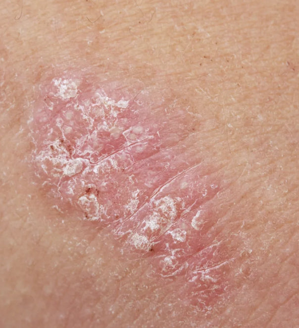 PSORIASIS Diet Plan